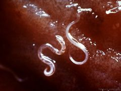 19 опасных для человека существ   Подкожный глист. Встречается в Африке и Йемене. Вместе с сырой водой ты можешь проглотить несколько водяных блох, зараженных паразитом.